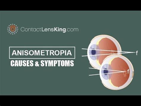 Anisometropia Causes and Symptoms - YouTube