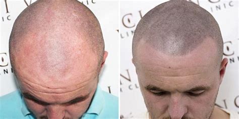 Bald Men Are Getting Head Tattoos To Hide Their Baldness