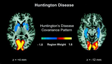 Metabolic Network Abnormalities in Early Huntington’s Disease: An [18F ...