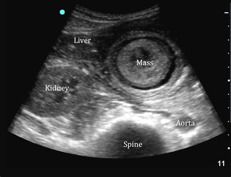 Unusual RUQ Scan in a Patient with Altered Mental Status | Emory School ...