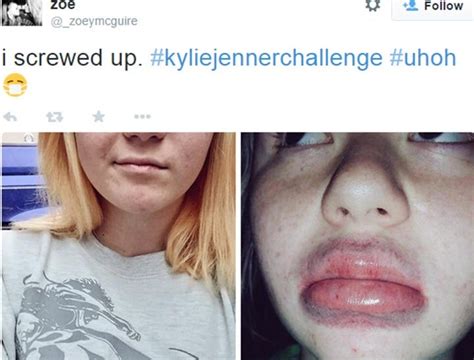 Teens do Kylie Jenner lip challlenge