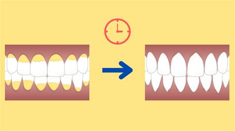 Are Coffee Stains on Teeth Permanent and How to Remove Them for Good?