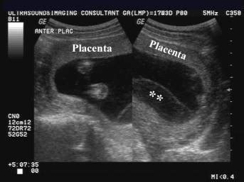 Ultrasound of Placental Hematoma and Abruption