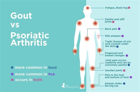 Gout vs. Psoriatic Arthritis: Differences in Symptoms and Treatments