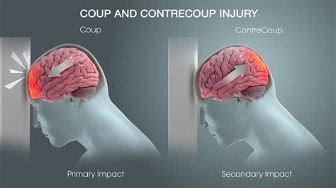 Understanding Hematomas and Traumatic Brain Injury - Scientific Animations