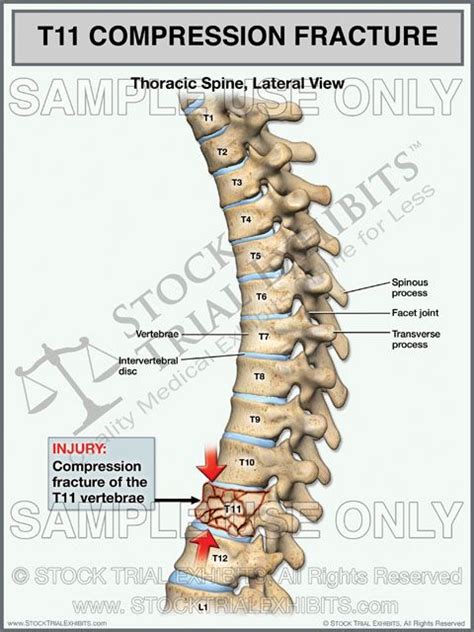 T11 Compression fracture of Thoracic Spine Stock Trial Exhibit ...