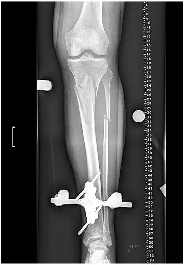 Tibia Fibula X Ray