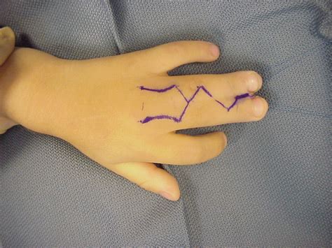 Birth: Syndactyly release incision planning potential pitfall