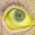 What is Scleral Icterus - Definiton, Symptoms, Causes, Treatment ...