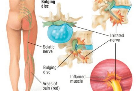 Nerve Pain In The Leg – Causes, Symptoms, Treatment, Exercise