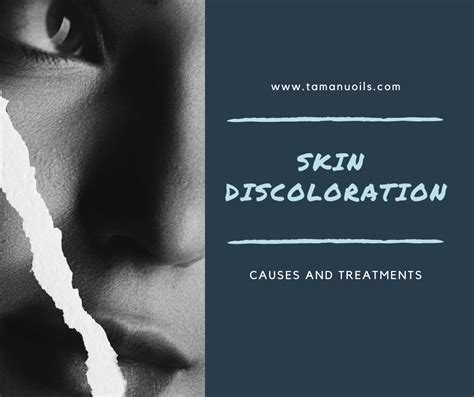 Skin Discoloration? Causes And Treatments