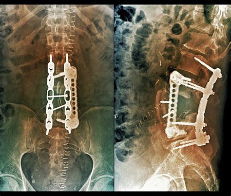 Implants Following Spinal Surgery Photograph by Zephyr/science Photo ...