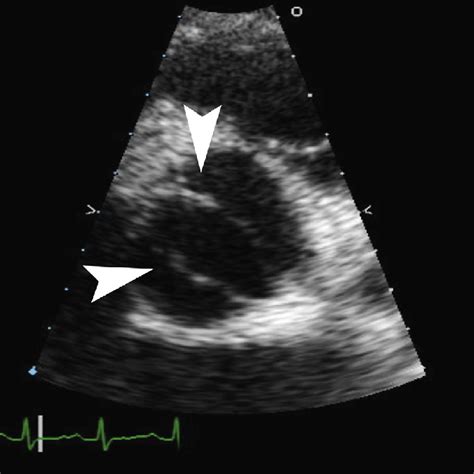 e Transthoracic echocardiogram parasternal short axis view of aortic ...