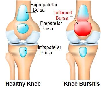 Knee Bursitis: Symptoms, Diagnosis & Treatment - Knee Pain Explained (2022)