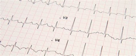 Bigeminy vs Trigeminy — SonoHealth.org