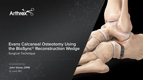 Arthrex - BioSync® Anatomic Reconstruction Wedge