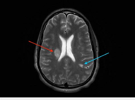 MRI brain demonstrating right periventricular, middle cerebral artery... | Download Scientific ...