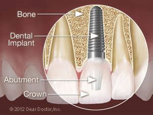 Dental Implant Surgery