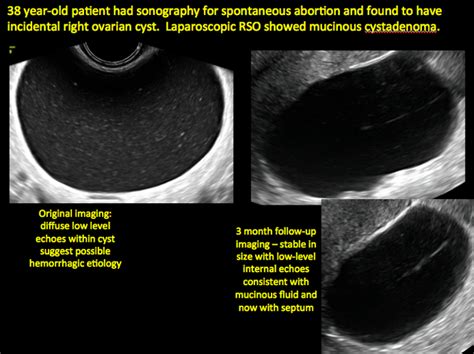 Ovarian Cyst And Cancer Ultrasound