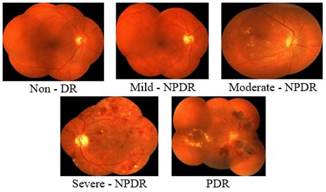 Severity stages of Diabetic Retinopathy | Download Scientific Diagram