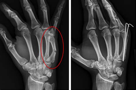 Hand Fracture - Raleigh Hand Surgery — Joseph J. Schreiber, MD