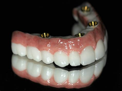 Snap on Dentures vs All on 4 Dental Solutions Explained