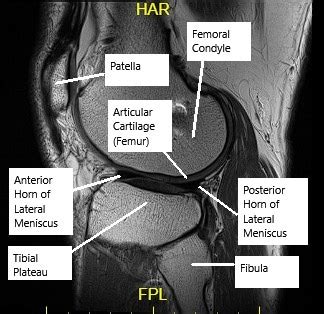 Knee Cartilage Injuries Management - Complete Orthopedics