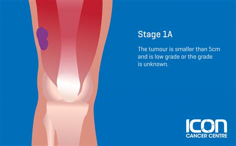 What is Soft Tissue Sarcoma? Soft Tissue Sarcoma Explained — Icon ...