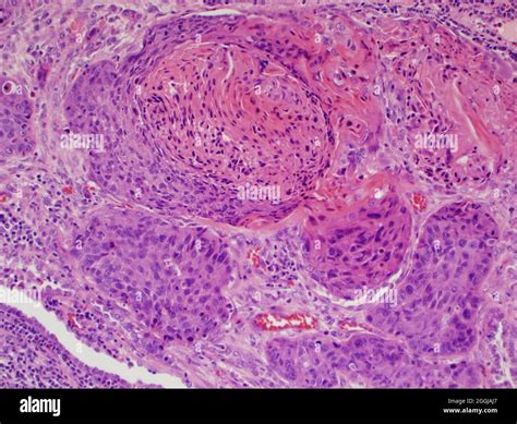 Squamous Cell Carcinoma Lung Histology