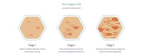 Pin on Hidradenitis Suppurativa Wound Care