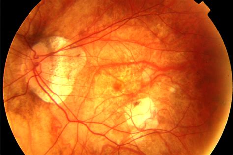 ¿Por qué el ojo con alta miopía tiene más riesgo de desprendimiento de retina? - Vissum