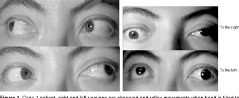 Figure 2 from [Skew deviation. Strabismological diagnosis and treatment ...