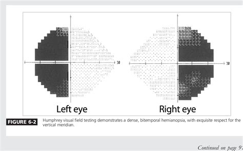 Figure 6-2 from Visual Loss Due to Optic Chiasm and Retrochiasmal Visual Pathway Lesions ...