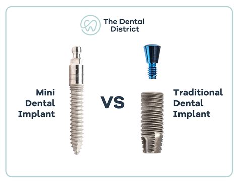 Mini Dental Implants Vs Traditional Dental Implants: Which one is right for you?