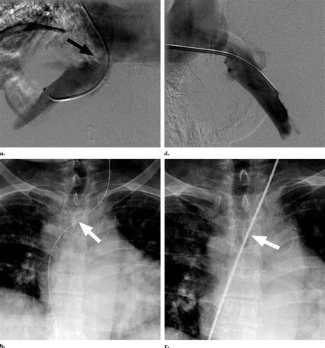 Transjugular Liver Biopsy via the Left Internal Jugular Vein - Journal of Vascular and ...