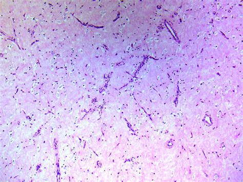 Dermatofibrosarcoma Protuberans Histology