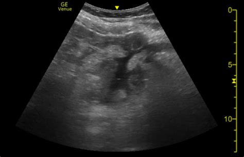 Abscess Archives - UCSD Ultrasound