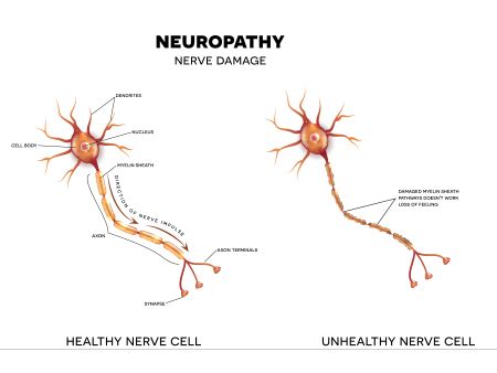 Nerve damage – Types, Symptoms, Causes, and Treatments