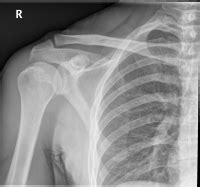 EMRad: Radiologic Approach to the Traumatic Shoulder