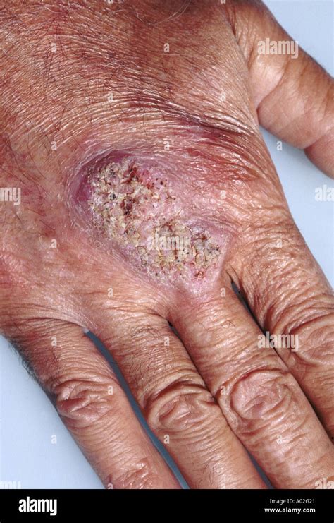 Blastomycosis hi-res stock photography and images - Alamy