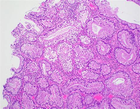 Pathology Outlines - Tubular adenoma