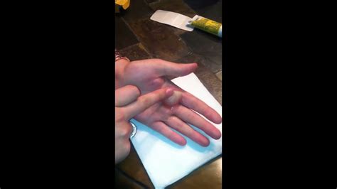 Popping my 2nd degree burn blister - YouTube