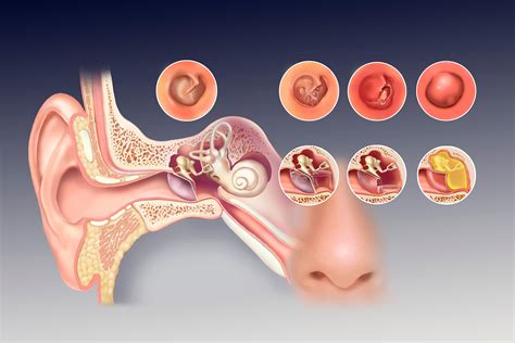 perforated eardrum Archives - Jackie Heda | Biomedical & Scientific Visuals