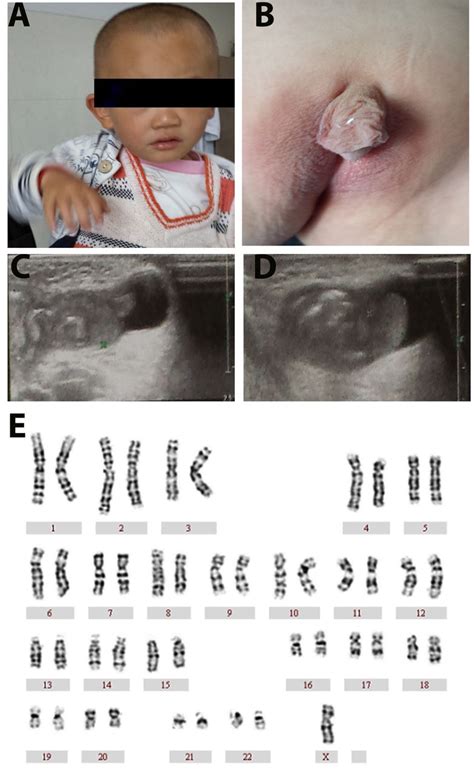 A Novel Sex Chromosome Mosaicism 45,X/45,Y/46,XY/46,YY/47,XYY Causing Ambiguous Genitalia