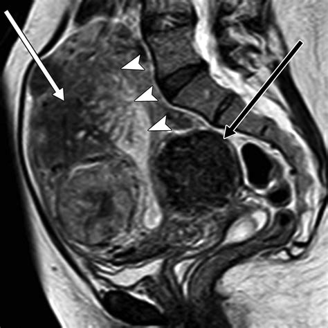 Uterus Anatomy Mri