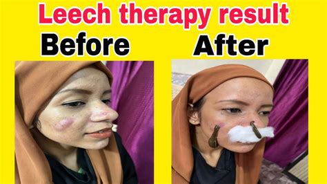 Is leech therapy good for face? Leech therapy pimples remove only 10 ...