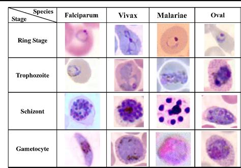 Plasmodium Species On Blood Smear Malaria Parasite Malaria Diagnosis | My XXX Hot Girl