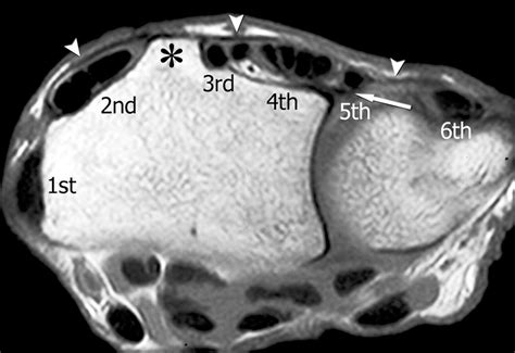 MRI: wrist compartments