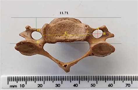 Morphometric parameters of foramen transversarium; A -anteroposterior ...