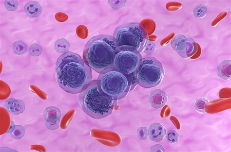 Blood Cancer Discovery IDs High-Risk Patients, Could Improve Outcomes